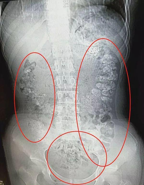 4岁女孩肚子疼，CT检查发现胃、肠、一直到…密密麻麻全是"